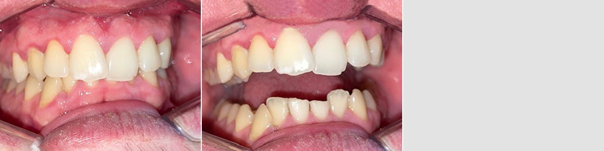 Caso 3 - Apiñamiento Dental y Mordida Cubierta - Imagen Después