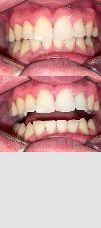 Caso 3 - Apiñamiento Dental y Mordida Cubierta - Imagen Antes