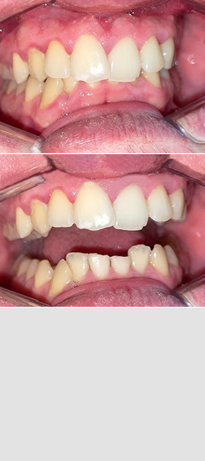 Caso 3 - Apiñamiento Dental y Mordida Cubierta - Imagen Después