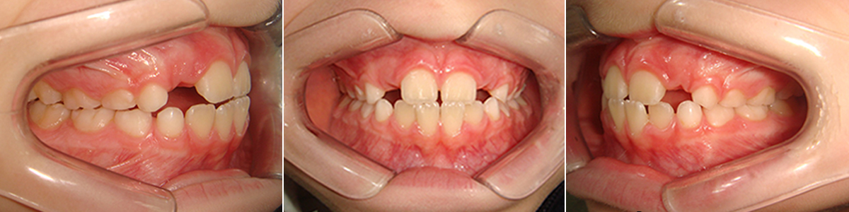 Caso 1 - Apiñamiento Dental y Mordida Cubierta - Imagen Después