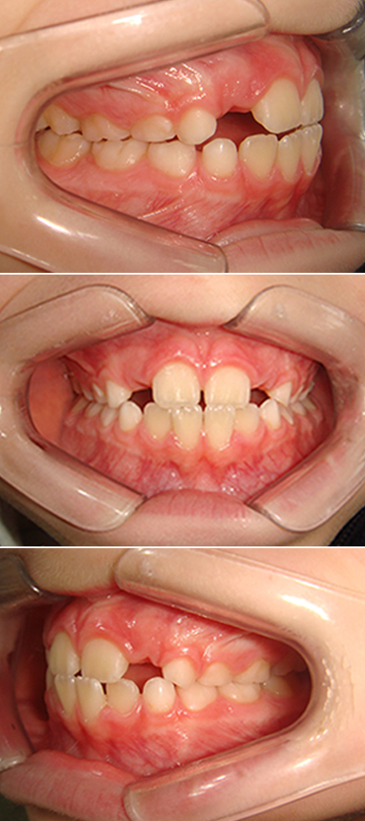 Caso 1 - Apiñamiento Dental y Mordida Cubierta - Imagen Después