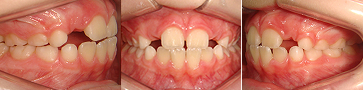 Casos 2 - Mordida Cruzada Unilateral - Imagen Después