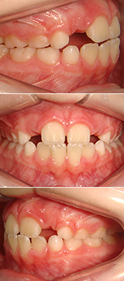 Casos 2 - Mordida Cruzada Unilateral - Imagen Después