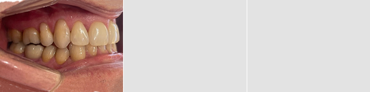 Caso 4 - Mordida Cruzada Unilateral - Imagen Antes