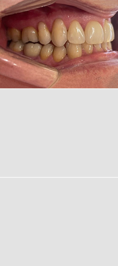 Caso 4 - Mordida Cruzada Unilateral - Imagen Antes