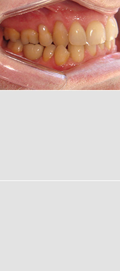 Casos 4 - Mordida Cruzada Unilateral - Imagen Después